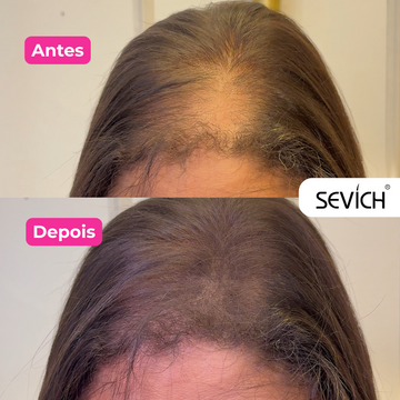 Alopecia Não Tira Apenas Cabelos. Ela Pode Tirar a Confiança de Muitas Pessoas.